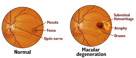 Age-Related Macular Degeneration Definition
