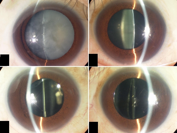 Cataract