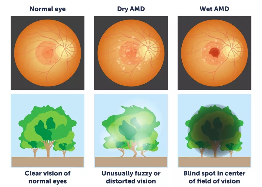 Normal, Dry and Wet AMD